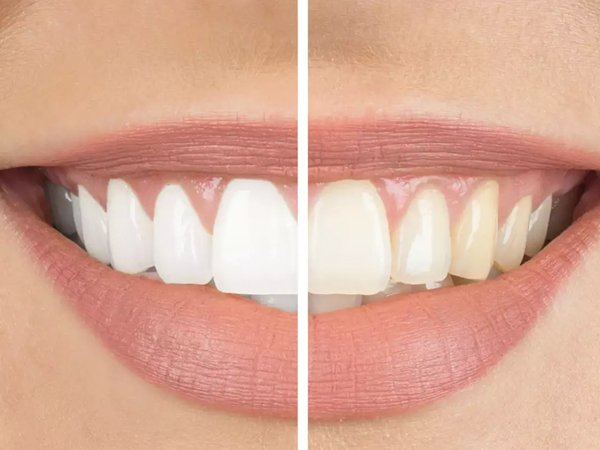 Tooth Whitening