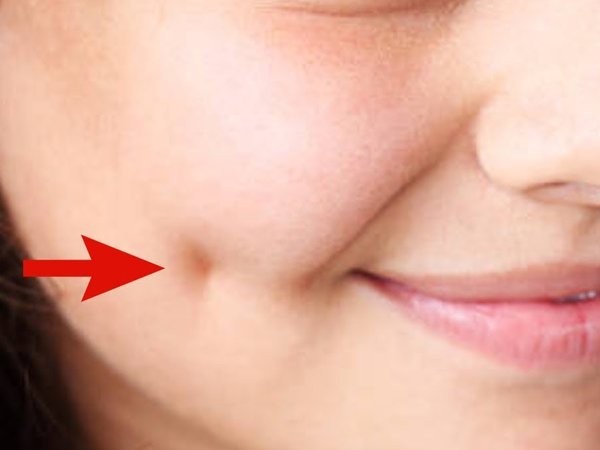 artificial dimpling