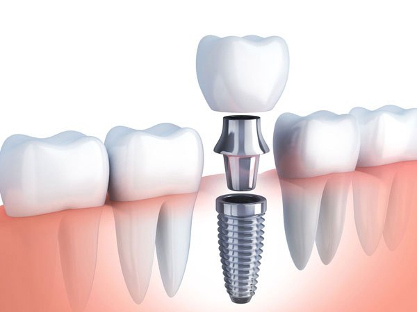 dental implant