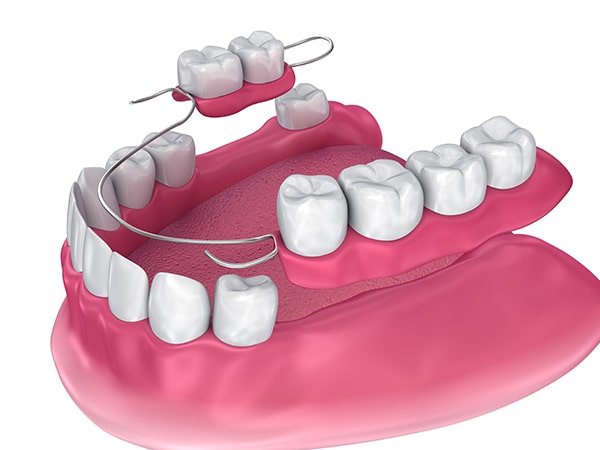 removable partial denture