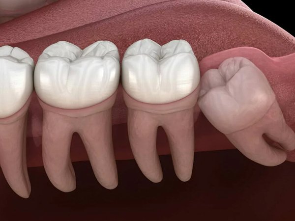 wisdom tooth